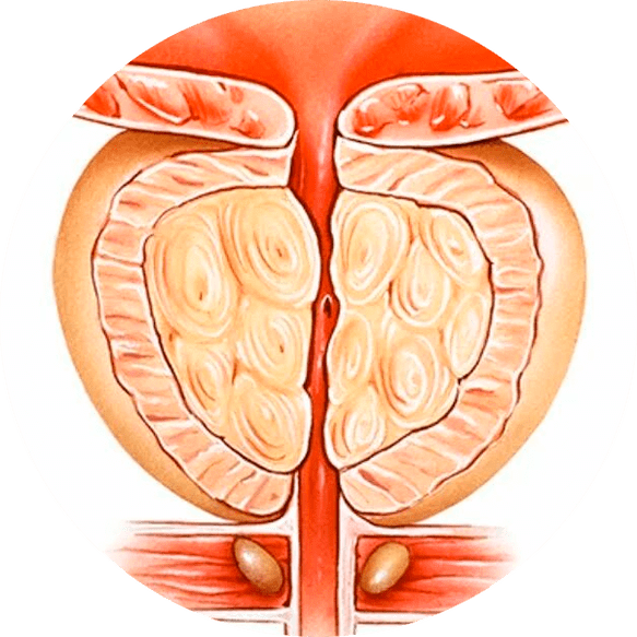 Tedavi edilmeyen prostatitin sonuçları